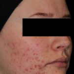 AviClear Before & After Patient #1672